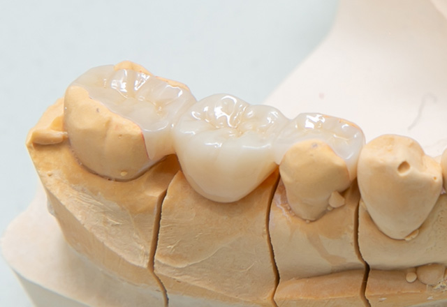 オールセラミック（ジルコニアフレーム+ポーセレン）